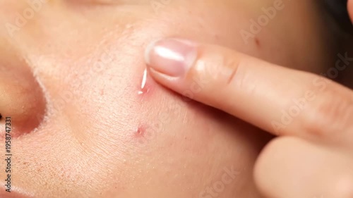 Woman applying medical serum on face skin with acne. Dropper dispensing clear skincare liquid to treat inflammation. Dermatological treatment and beauty concept.