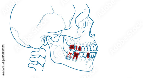 A blue outline illustration of a human skull and jaw highlights several red molar teeth on a white background.