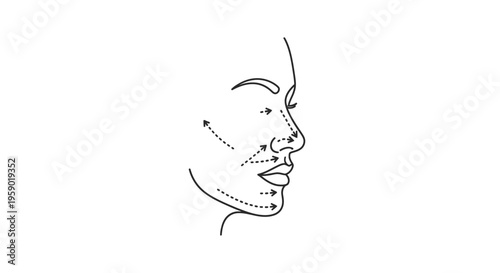 Facial lines and arrows indicating cosmetic surgery or treatment areas on a profile view