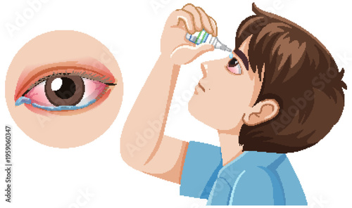 Boy Using Eye Drops for Red Irritated Eye