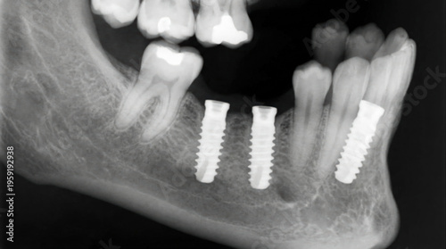 Dental X-ray showing multiple titanium implants in the lower jaw, panoramic radiograph of jawbone with screw restorations, stomatology and oral surgery concept.
