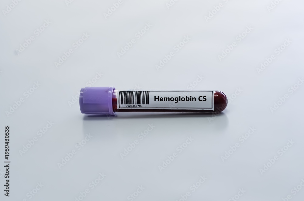 Fototapeta premium Blood sample tube for hemoglobin CS test analysis.