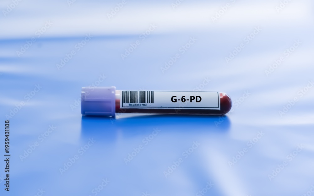 Fototapeta premium Blood sample tube for G-6-PD test analysis.