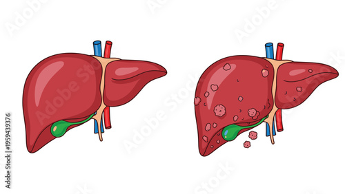 Educational medical illustration comparing a healthy human liver with a diseased liver showing tumors and inflammation for health awareness.
