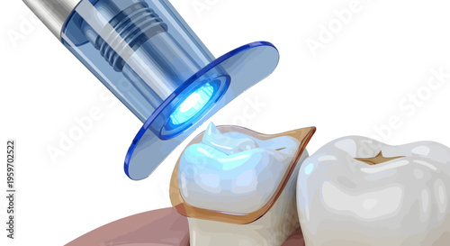 A dental tool shines blue light on a tooth with a dental filling in a clinic