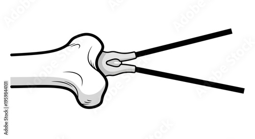 Medical illustration of bone repair with pins.