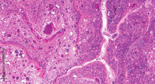 High magnification liver tissue with pigment linked pathological alterations and abnormal cells stained with haematoxylin and eosin