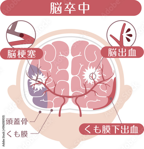 Stroke Types Medical Illustration