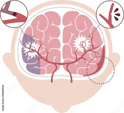 Stroke Types Medical Illustration