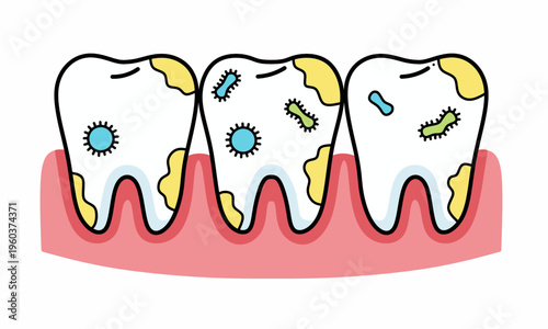 Dental plaque and bacteria on teeth illustration for oral health education and gum disease prevention
