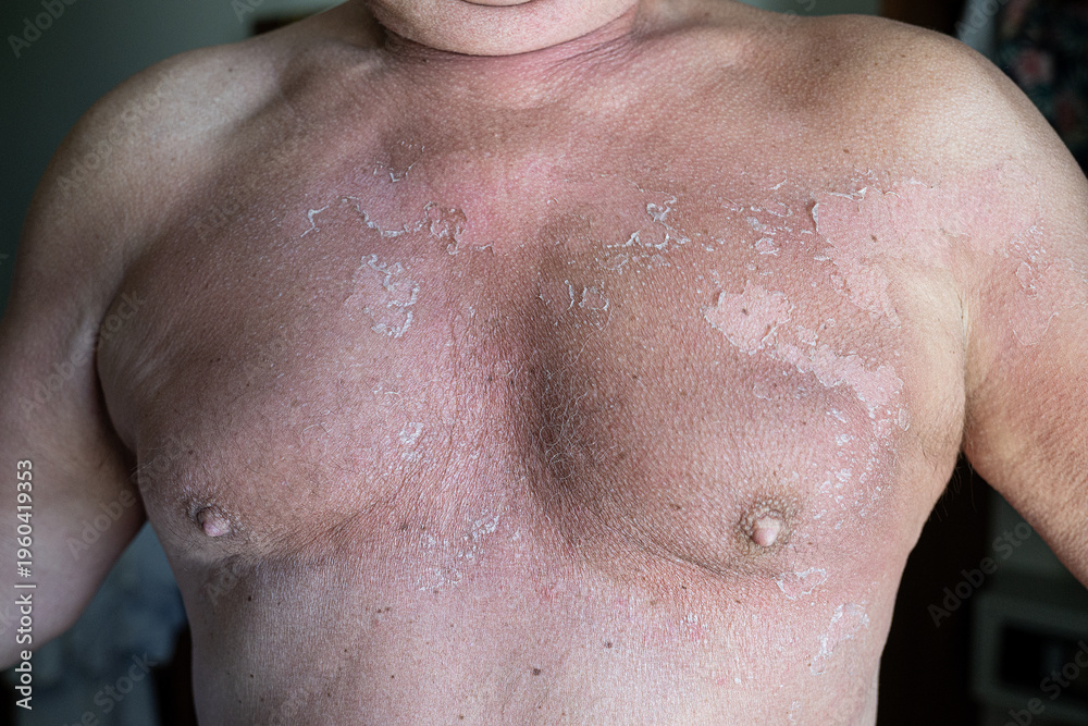 Naklejka premium Peeling sunburned chest skin in summer sun showing flaking redness and textured torso revealing damaged epidermis and discomfort
