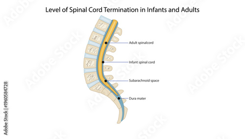Level of Spinal Cord Termination in Infants and Adults,Diagram showing the difference in spinal cord termination levels in infants and adults along with the subarachnoid space and dura mater.