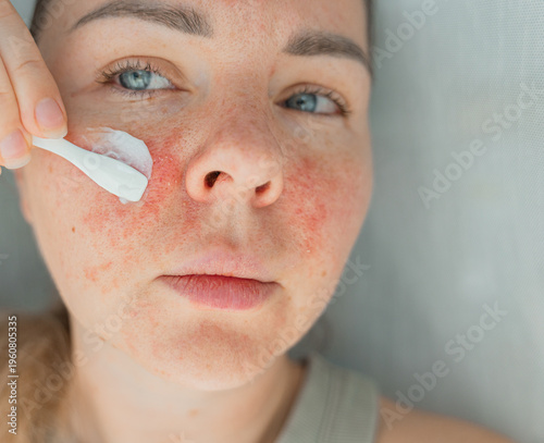 Obraz na plátně Close-up woman applying cream to red, irritated skin on her cheek after sunburn, cosmetic peeling, or skin damage