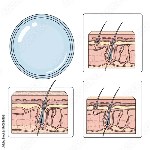 Detailed illustration of skin layers and hair follicle structure for educational purposes.