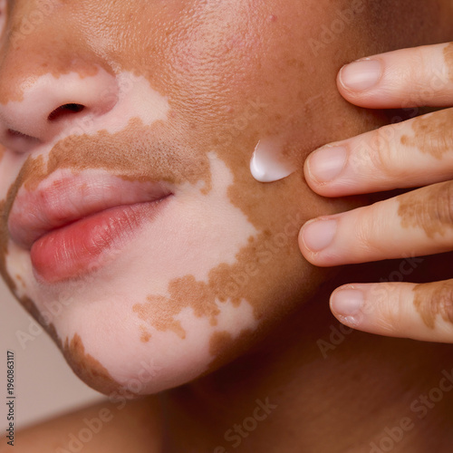 Close-up of person with vitiligo applying face cream