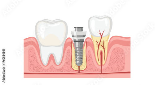 A cross-section diagram illustrates a dental implant positioned between two teeth within the gum and bone structure.