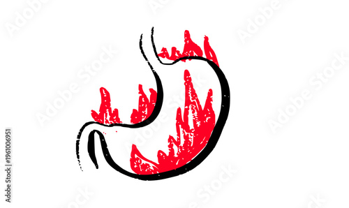 Gastroesophageal reflux pain