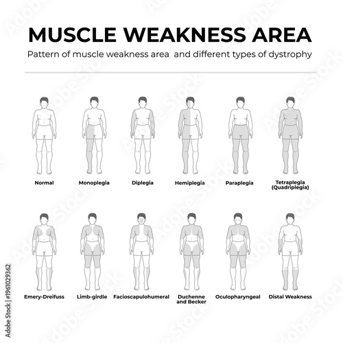 10_pattern of muscle weakness area and different type of dystrophy flat line illustration