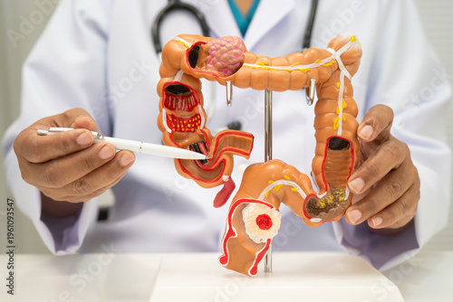 Konstfotografi Colorectal cancer, doctor holding intestine colon human anatomy model