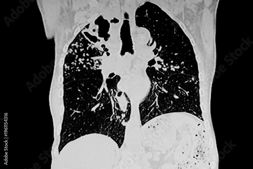 Medical themes: CAT Scan of tuberculous cavity in the right upper lobe and fibronodular infiltrate