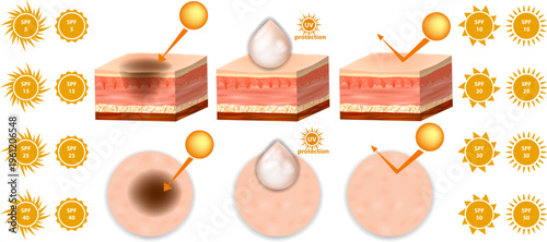 Sunscreen SPF Protection Levels Skin Layers UV Radiation Infographic Illustration. Sun Exposure and SPF Defense Skin Anatomy Comparison Medical Illustration