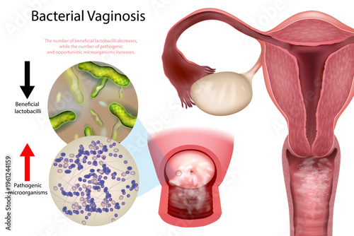 Bacterial Vaginosis Medical Illustration Female Reproductive System Microbiome Imbalance Diagram. Vaginal Microflora Disruption Anatomy Infographic Lactobacilli Decrease Pathogenic Bacteria Increase