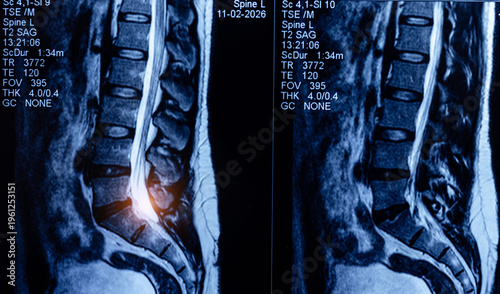 Bild auf Leinwand Sagittal lumbar spine mri scan with highlighted disc region for clinical diagnos