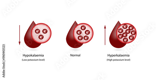 Hyperkalaemia, high plasma potassium level and Hypokalaemia, low plasma potassium level. Potassium K excess and deficit electrolyte disorders, blood test tube, Scientific design. Vector illustration