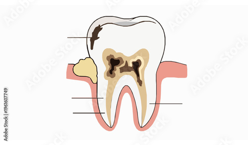 Front tooth decay dental caries educational vector illustration