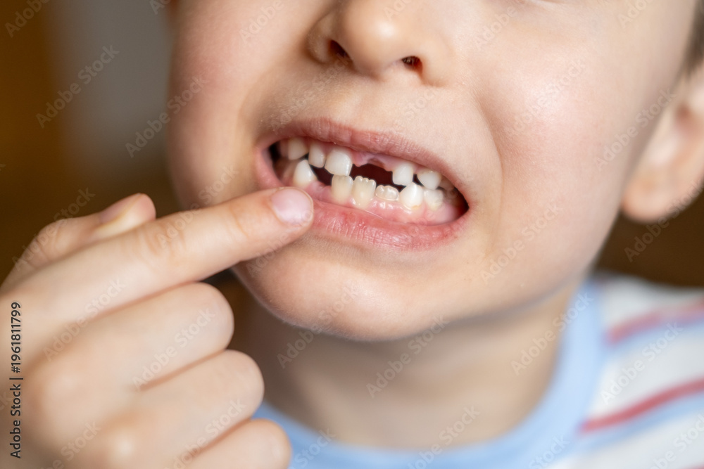 Fototapeta premium A cheerful child proudly showing a missing upper milk tooth. Concept of childhood growth, dental development, and family moments. Perfect for pediatric dentistry, tooth loss.