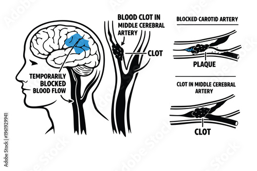 Medical illustration showing different causes and locations of blood clots in the human brain area Vector
