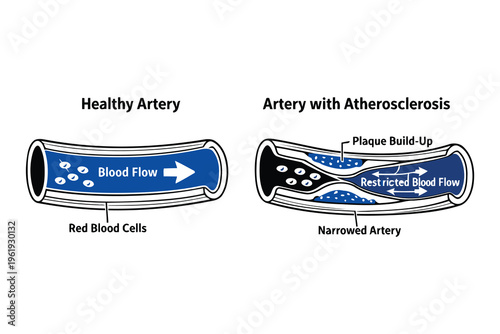 A medical diagram comparing the blood flow in a healthy artery versus one with atherosclerosis Vector
