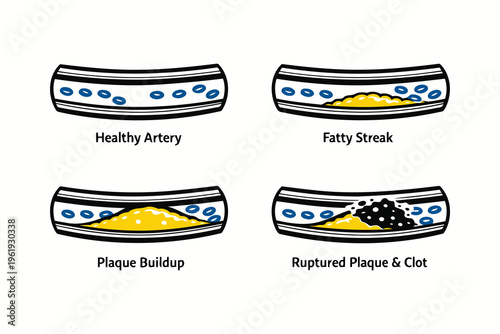 Medical illustration showing the progression of atherosclerosis from a healthy artery to a clot Vector