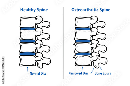A medical comparison illustration showing the difference between a healthy and arthritic spine Vector