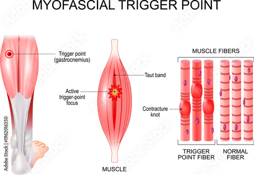 Myofascial trigger point in leg. Muscle fibers with contracture knots and taut band