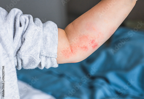 Foto small hand of child covered by eczema