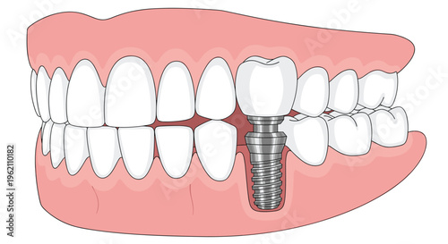 A detailed cross-section illustration of a human jaw shows a dental implant replacing a molar with a metal screw and crown.