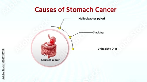  Causes of Stomach Cancer  Infographic Medical Animation