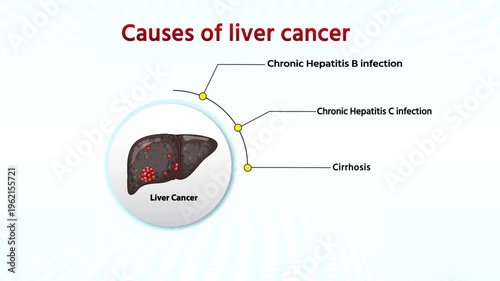 Liver Cancer Causes Infographic Medical Animation