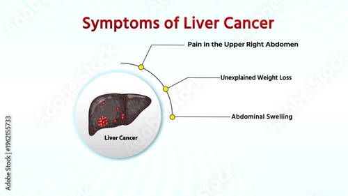  Symptoms Liver Cancer . Infographic Medical Animation