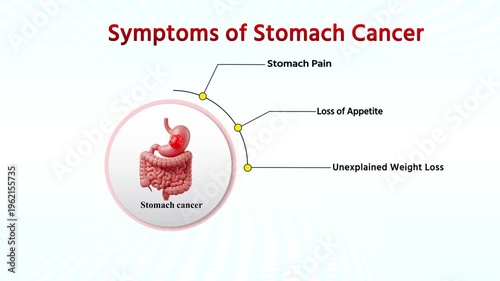 Symptoms of Stomach Cancer Medical Animation