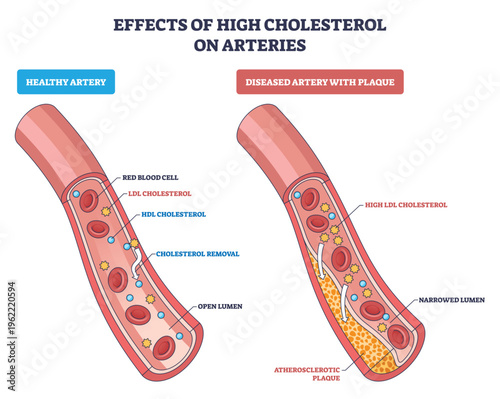 High cholesterol effects on arteries shown by plaque buildup narrowing the lumen, key elements are artery wall, atherosclerotic plaque, red blood cells. Outline diagram