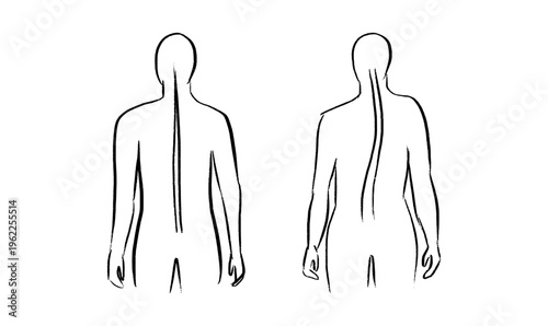 Scoliosis spine deformity