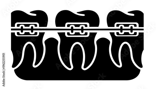 Orthodontic Braces System on Teeth Row with Brackets and Arch Wire Alignment Treatment