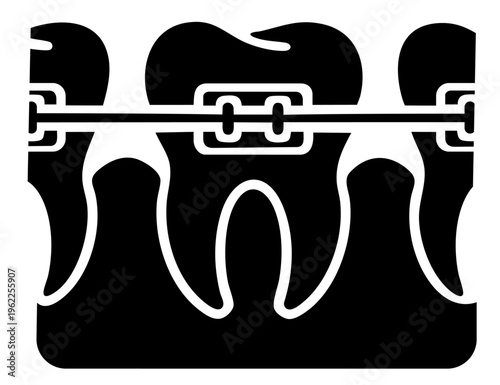 Orthodontic Braces Close Up on Teeth with Brackets and Wire for Detailed Alignment Correction