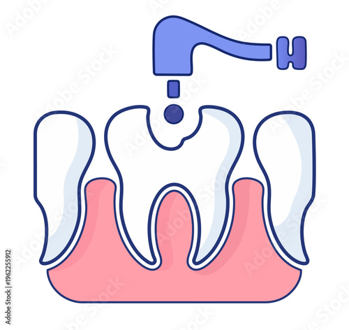 Dental Drill Treating Tooth Cavity, Dentist Handpiece Cleaning Decay, Caries Removal and Tooth Preparation Procedure