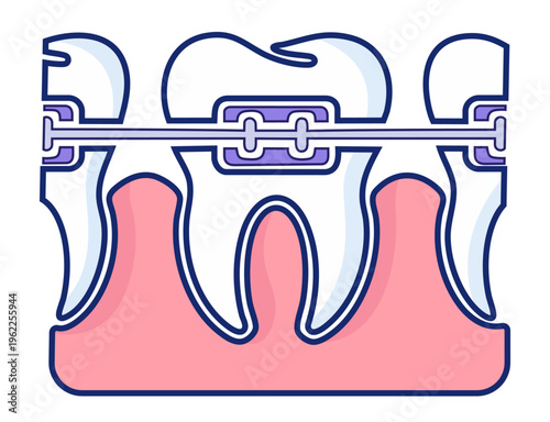 Dental Braces on Teeth, Orthodontic Brackets and Wire for Bite Correction and Teeth Alignment