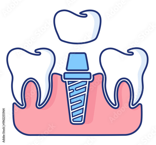 Dental Implant Screw Placement in Jaw, Artificial Tooth Replacement with Crown, Implant Dentistry Procedure