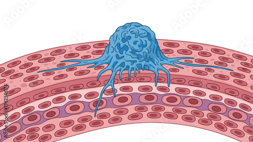 Large, abnormal blue cell with tentacles on a layer of human tissue with red blood cells, depicting a cancer cell or tumor.