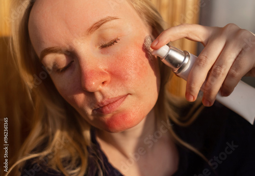 Gentle skincare for sensitive skin with rosacea and couperose: anti-redness serum to soothe or after sunburn. Concept of treatment, recovery, and daily facial skin care routine.